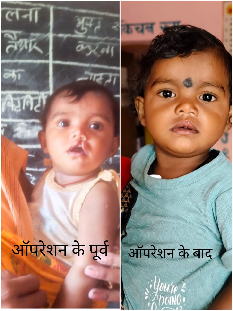 चिरायु दल ने लौटाई मासूम रंजना की मुस्कान